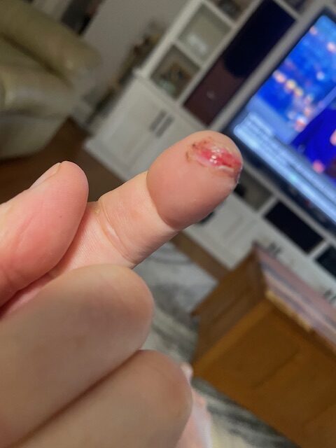 Slight cut on a finger after SawStop safety system activated